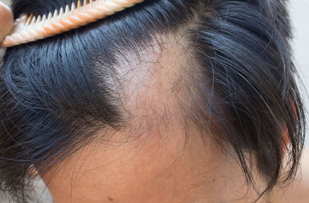 les causes-d'une-alopecie-cicatricielle